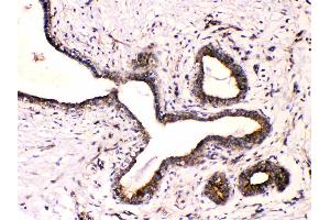 Beta III Tubulin was detected in paraffin-embedded sections of human mammary cancer tissues using rabbit anti- Beta III Tubulin Antigen Affinity purified polyclonal antibody (Catalog # ) at 1 µg/mL. (TUBB3 抗体  (C-Term))