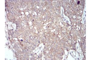 Immunohistochemical analysis of paraffin-embedded bladder cancer tissues using NOX4 mouse mAb with DAB staining. (NADPH Oxidase 4 抗体  (AA 210-310))