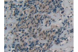IHC-P analysis of Human Breast cancer Tissue, with DAB staining. (DBH 抗体  (AA 335-571))