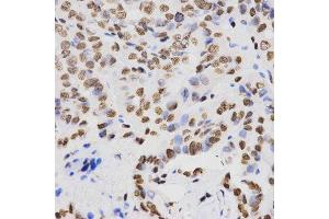 Immunohistochemistry of paraffin-embedded human thyroid cancer using DiMethyl-Histone H4-K20 antibody.