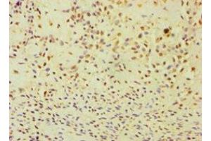 Immunohistochemistry of paraffin-embedded human breast cancer using ABIN7144295 at dilution of 1:100 (ANXA8L2 抗体  (AA 1-276))