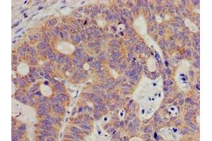 Immunohistochemistry of paraffin-embedded human colon cancer using ABIN7169599 at dilution of 1:100 (SIGMAR1 抗体  (AA 112-169))