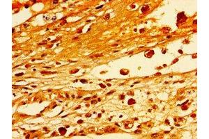 Immunohistochemistry of paraffin-embedded human melanoma using ABIN7171253 at dilution of 1:100 (STXBP1 抗体  (AA 245-594))