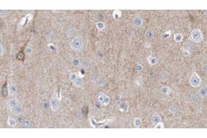 ABIN6278328 at 1/100 staining Human brain cancer tissue by IHC-P. (DCTN3 抗体  (N-Term))