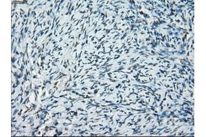 Immunohistochemical staining of paraffin-embedded Adenocarcinoma of breast tissue using anti-PRKY mouse monoclonal antibody. (PRKY 抗体)