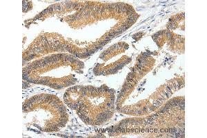 Immunohistochemistry of Human lung cancer using MDK Polyclonal Antibody at dilution of 1:60 (Midkine 抗体)