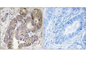 Immunohistochemistry analysis of paraffin-embedded human colon carcinoma, using CAD (Phospho-Thr456) Antibody. (CAD 抗体  (pThr456))