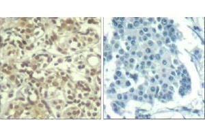 Immunohistochemical analysis of paraffin-embedded human breast carcinoma tissue using AKT1 (phospho- Thr450) Antibody (E011502). (AKT1 抗体  (pThr450))