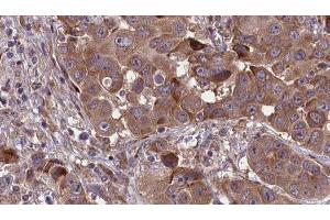 ABIN6277679 at 1/100 staining Human liver cancer tissue by IHC-P. (Serotonin Receptor 3A 抗体  (Internal Region))