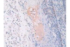 Detection of FGFR3 in Human Skin cancer Tissue using Polyclonal Antibody to Fibroblast Growth Factor Receptor 3 (FGFR3) (FGFR3 抗体  (AA 166-375))