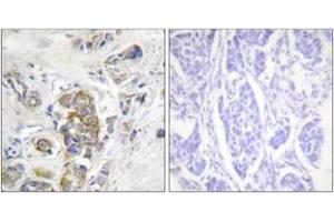 Immunohistochemistry analysis of paraffin-embedded human breast carcinoma, using ITGB4 (Phospho-Tyr1510) Antibody. (Integrin beta 4 抗体  (pTyr1510))