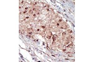 Formalin-fixed and paraffin-embedded human cancer tissue (hepatocarcinoma) reacted with the primary antibody, which was peroxidase-conjugated to the secondary antibody, followed by AEC staining. (SPHK1 抗体  (AA 286-315))