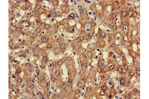 Immunohistochemistry of paraffin-embedded human liver cancer using ABIN7147936 at dilution of 1:100 (CLASP2 抗体  (AA 226-381))