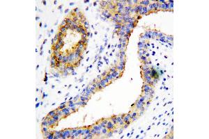 Anti-BCAT1 antibody, IHC(P) IHC(P): Human Mammary Cancer Tissue
