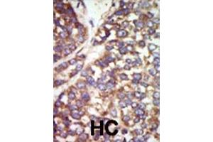 Formalin-fixed and paraffin-embedded human cancer tissue reacted with the primary antibody, which was peroxidase-conjugated to the secondary antibody, followed by DAB staining. (PAK2 抗体  (N-Term))