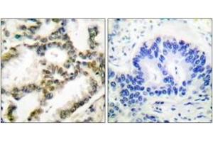 Immunohistochemistry analysis of paraffin-embedded human lung carcinoma tissue, using DJ-1 Antibody. (PARK7/DJ1 抗体  (AA 21-70))