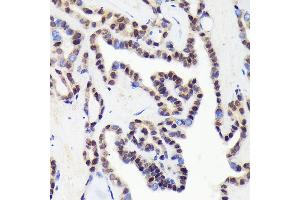 Immunohistochemistry of paraffin-embedded human thyroid cancer using CDC Rabbit mAb (ABIN1682192, ABIN3018455, ABIN3018456 and ABIN7101613) at dilution of 1:100 (40x lens). (CDCA5 抗体)