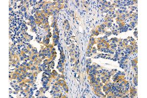 ABIN6257319 and ABIN6276046 at 1/100 staining Human lung cancer by IHC-P. (MC4R 抗体  (C-Term))