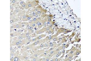 Immunohistochemistry of paraffin-embedded Human liver damage using MGAT1 Polyclonal Antibody at dilution of 1:100 (40x lens). (MGAT1 抗体)