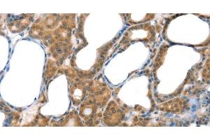 Immunohistochemistry of paraffin-embedded Human thyroid cancer tissue using Laminin alpha4 Polyclonal Antibody at dilution 1:30 (LAMa4 抗体)