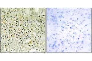 Immunohistochemistry analysis of paraffin-embedded human prostate carcinoma tissue, using LEG8 Antibody. (LGALS8 抗体  (AA 61-110))