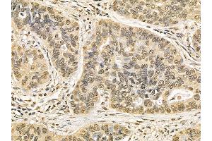 NUP50 Mouse Monoclonal Antibody at 1/100 staining human lung cancer and adjacent non-tumor tissue by IHC-P. (NUP50 抗体)