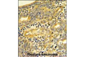 DPP8 Antibody IHC analysis in formalin fixed and paraffin embedded human Prostate carcinoma followed by peroxidase conjugation of the secondary antibody and DAB staining. (DPP8 抗体  (C-Term))