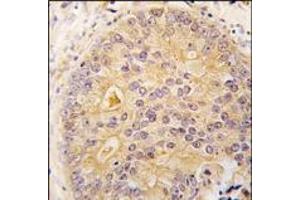 Formalin-fixed and paraffin-embedded human prostata carcinoma tissue reacted with CAMKK2 antibody (N-term), which was peroxidase-conjugated to the secondary antibody, followed by DAB staining. (CAMKK2 抗体  (N-Term))