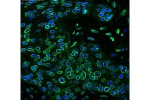 IHC testing of FFPE human lung cancer tissue with Emerin antibody at 1ug/ml. (Emerin 抗体  (AA 1-48))