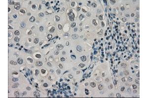 Immunohistochemical staining of paraffin-embedded Adenocarcinoma of ovary tissue using anti-CRYABmouse monoclonal antibody. (CRYAB 抗体)