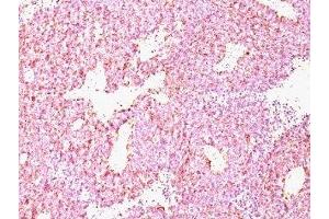 Formalin-paraffin human SC lung carcinoma stained with Chromogranin A antibody (CHGA/798) (Chromogranin A 抗体)