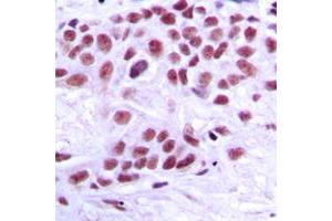 Immunohistochemical analysis of TRAP220 staining in human breast cancer formalin fixed paraffin embedded tissue section. (MED1 抗体  (Center))
