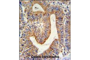 RPL17 Antibody IHC analysis in formalin fixed and paraffin embedded colon carcinoma followed by peroxidase conjugation of the secondary antibody and DAB staining. (RPL17 抗体  (C-Term))