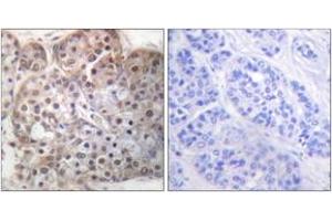 Immunohistochemistry analysis of paraffin-embedded human breast carcinoma, using STAT5A/B (Phospho-Ser725/730) Antibody. (STAT5 A/B 抗体  (pSer726))