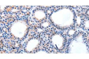 Immunohistochemistry of paraffin-embedded Human thyroid cancer using HCN1 Polyclonal Antibody at dilution of 1:50 (HCN1 抗体)