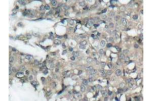 Immunohistochemistry analyzes of MEK1/2 antibody in paraffin-embedded human breast carcinoma tissue. (MEK1 抗体)