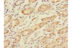 Immunohistochemistry of paraffin-embedded human gastric cancer using ABIN7166195 at dilution of 1:100 (TOB2 抗体  (AA 1-70))