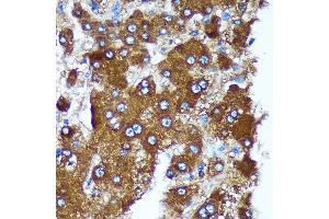 Immunohistochemistry of paraffin-embedded Human liver cancer using PIGU Rabbit pAb (ABIN7269291) at dilution of 1:100 (40x lens). (PIGU 抗体)