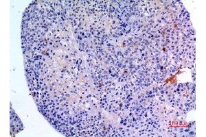 Immunohistochemistry (IHC) analysis of paraffin-embedded Human Liver Cancer, antibody was diluted at 1:100. (BMP3 抗体  (C-Term))