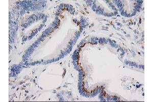 Immunohistochemical staining of paraffin-embedded Adenocarcinoma of Human colon tissue using anti-IRF6 mouse monoclonal antibody. (IRF6 抗体)