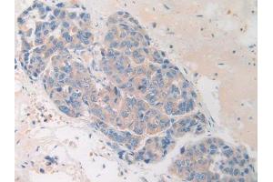 IHC-P analysis of Human Breast cancer Tissue, with DAB staining. (HAND1 抗体  (AA 1-215))
