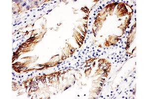 Anti-Integrin beta 4 Picoband antibody,  IHC(P): Human Intestinal Cancer Tissue (Integrin beta 4 抗体  (AA 28-266))