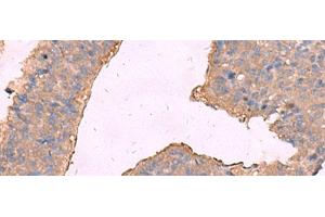 Immunohistochemistry of paraffin-embedded Human liver cancer tissue using KCNN2 Polyclonal Antibody at dilution of 1:65(x200) (KCNN2 抗体)