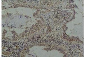 Immunohistochemical analysis of paraffin-embedded Human Lung Caricnoma using Phosphoserine Mouse mAb diluted at 1:200. (Phosphoserine 抗体)