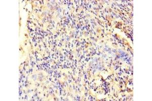 Immunohistochemistry of paraffin-embedded human cervical cancer using ABIN7151766 at dilution of 1:100 (ECEL1 抗体  (AA 425-775))