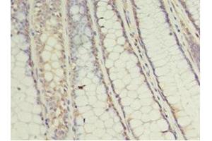 Immunohistochemistry of paraffin-embedded human colon cancer using ABIN7174430 at dilution of 1:100 (UBE2C 抗体  (AA 2-179))