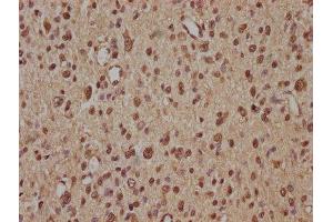 IHC image of ABIN7140239 diluted at 1:100 and staining in paraffin-embedded human glioma performed on a Leica BondTM system. (Znf423 抗体  (AA 39-57))