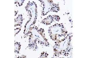 Immunohistochemistry of paraffin-embedded human thyroid cancer using [KO Validated] PDCD4 Rabbit pAb (ABIN3023387, ABIN3023388, ABIN3023389 and ABIN1681284) at dilution of 1:25 (40x lens). (PDCD4 抗体  (AA 1-260))