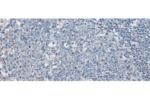 Immunohistochemistry of paraffin-embedded Human tonsil tissue using LASP1 Polyclonal Antibody at dilution of 1:35(x200)