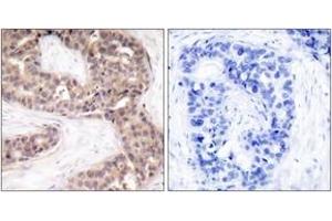 Immunohistochemistry analysis of paraffin-embedded human breast carcinoma tissue, using G3BP-1 (Ab-232) Antibody.